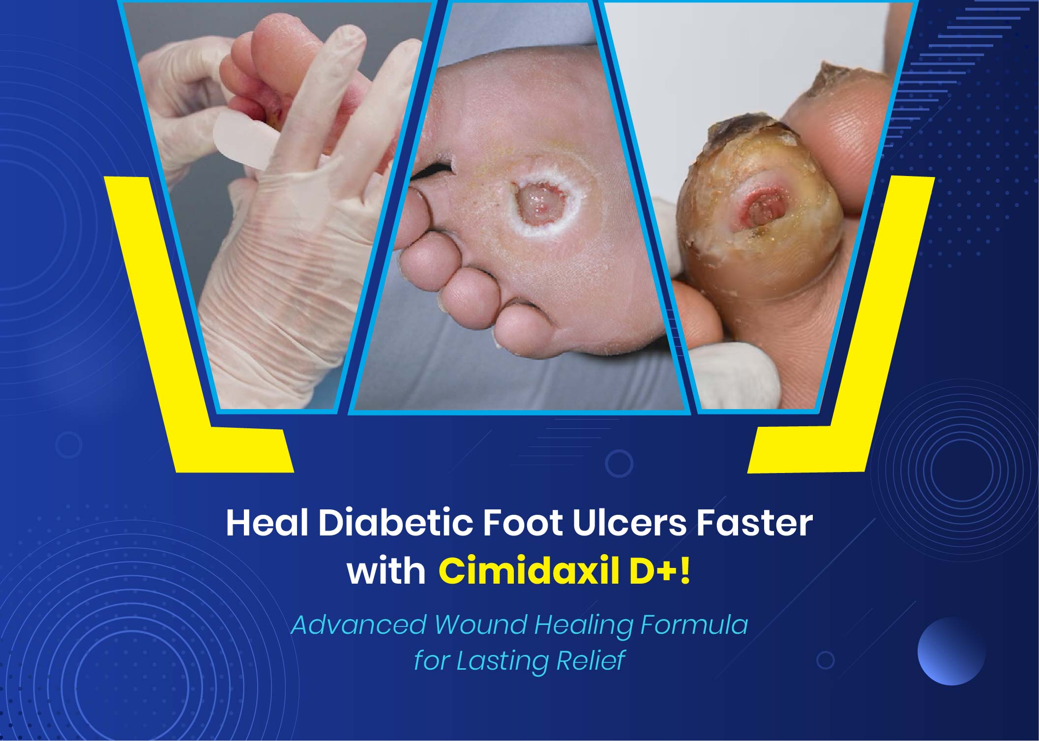 diabetic foot ulcers