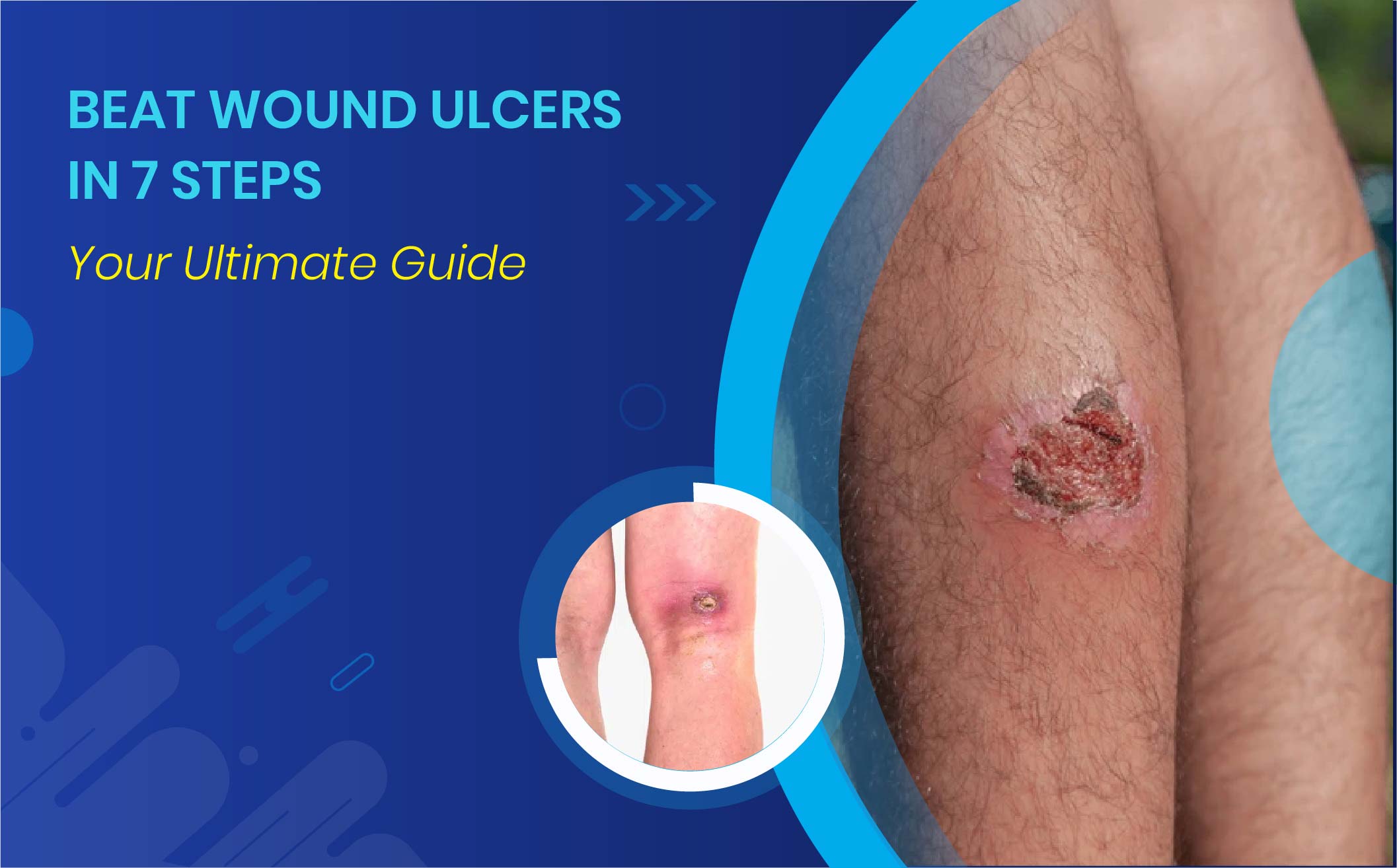 wound ulcers